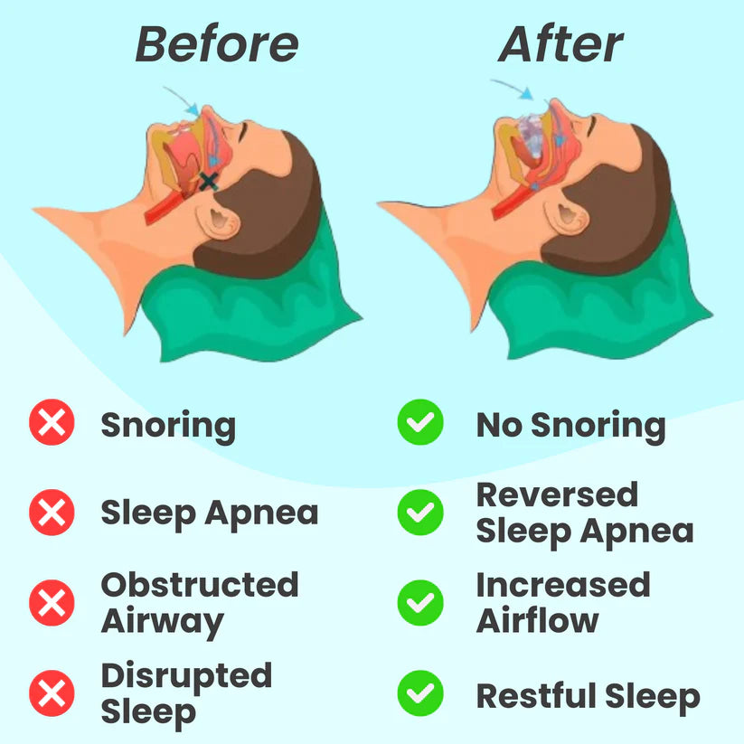 Mouthpiece Anti-Snore